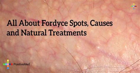 grain de fordyce|What they are, Causes, Symptoms and Treatments